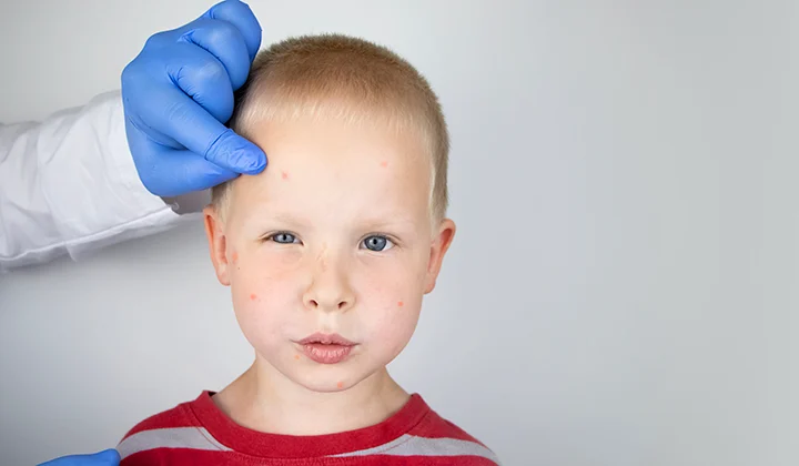 What Parents Need to Know About Measles — And How to Protect Your Family